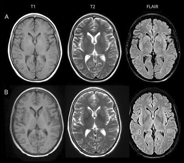 MRI-brain